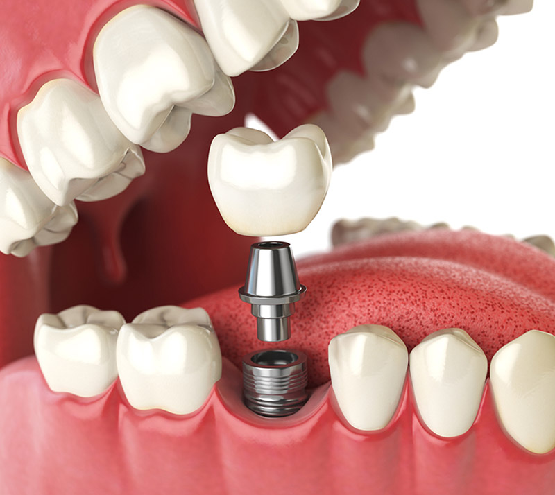 Dental Implant Calgary